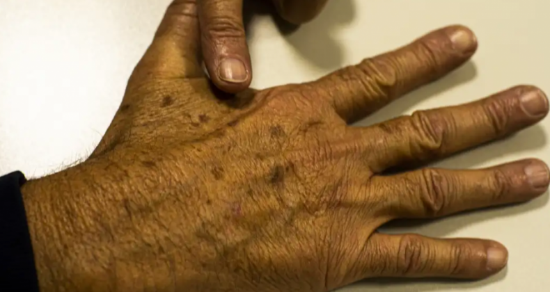 Câncer de pele gera R$ 4,6 mi em custos hospitalares em quase 2 anos