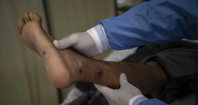 RS tem mais de 80 casos confirmados de varíola do macaco